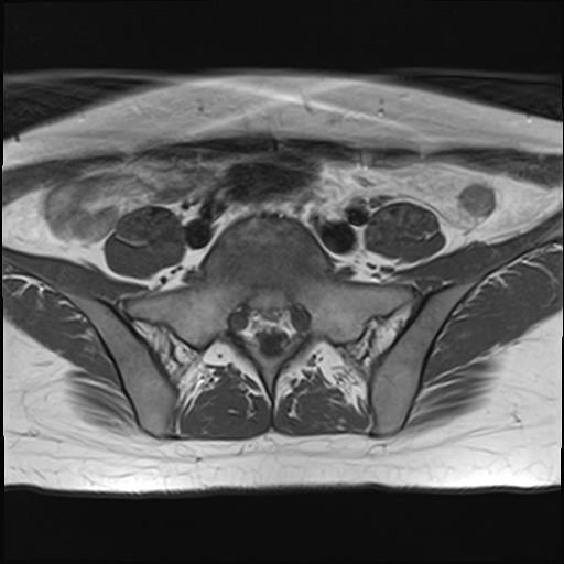 File:Bilateral ovarian endometriomas (Radiopaedia 87085-103347 Axial T1 1).jpg