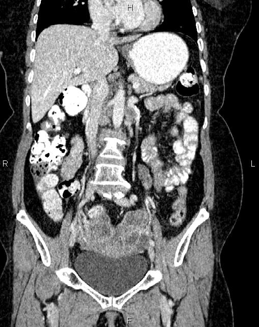 Bilateral ovarian serous cystadenocarcinoma (Radiopaedia 86062-101989 D 20).jpg