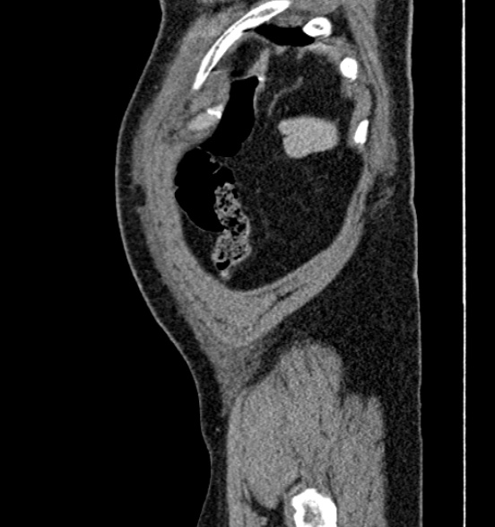 File:Bilateral rectus sheath hematomas (Radiopaedia 50778-56252 B 72).jpg