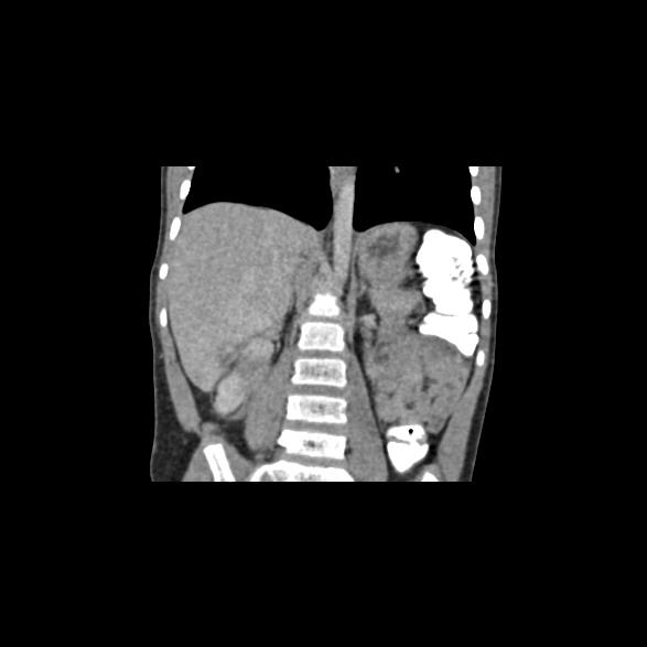 File:Bilateral renal malrotation (Radiopaedia 30901-31606 B 4).jpg
