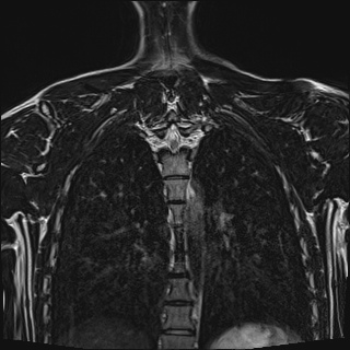 File:Bilateral spinoglenoid notch ganglion cysts (Radiopaedia 29577-30082 Coronal T2 98).jpg
