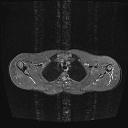 File:Bilateral spinoglenoid notch ganglion cysts (Radiopaedia 29577-30082 E 10).jpg