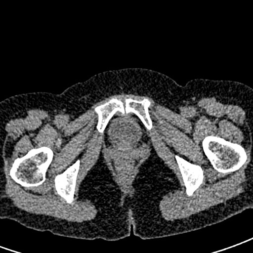 Bilateral staghorn calculi (Radiopaedia 59475-66842 Axial non-contrast 88).jpg