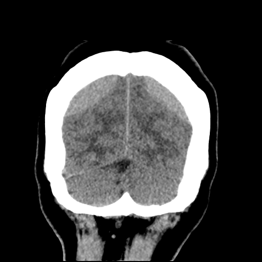 Bilateral subacute subdural hematoma (Radiopaedia 69240-79018 Coronal non-contrast 50).jpg