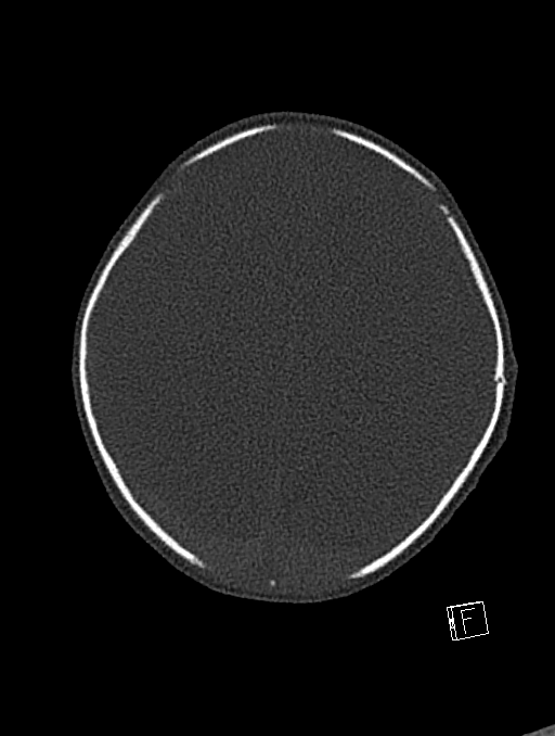 Bilateral subdural hemorrhage and parietal skull fracture (Radiopaedia 26058-26192 Axial bone window 32).png