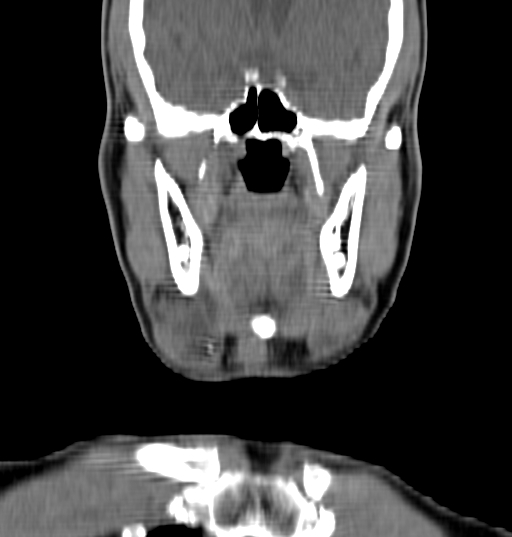 Bilateral submandibular sialolithiasis with sialadenitis (Radiopaedia 70721-80881 Coronal non-contrast 24).jpg