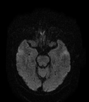 File:Bilateral thalamic glioma (Radiopaedia 65852-75009 Axial DWI 7).jpg