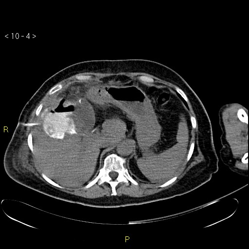 File:Biloma with drainage into the colon (Radiopaedia 20032-20068 B 4).jpg