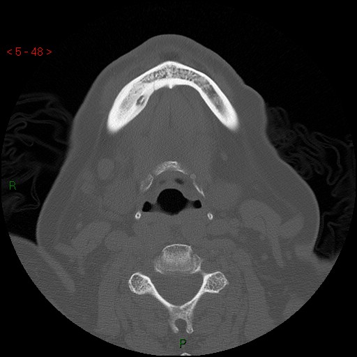 Bisphosphonate-related osteonecrosis of the jaw (Radiopaedia 54147-60329 Axial bone window 42).jpg