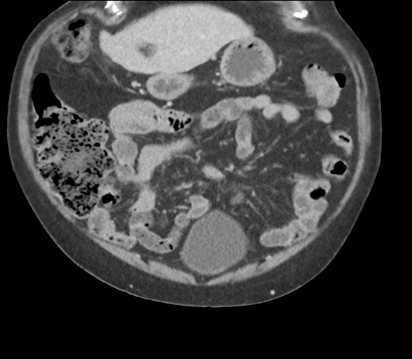 File:Bladder papillary urothelial carcinoma (Radiopaedia 48119-52951 C 20).png