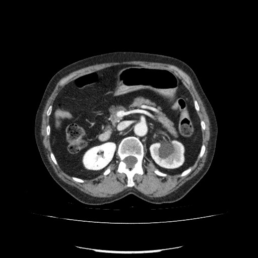 File:Bladder tumor detected on trauma CT (Radiopaedia 51809-57609 B 48).jpg
