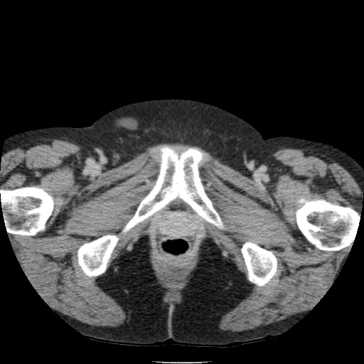 Bladder tumor detected on trauma CT (Radiopaedia 51809-57609 C 145).jpg