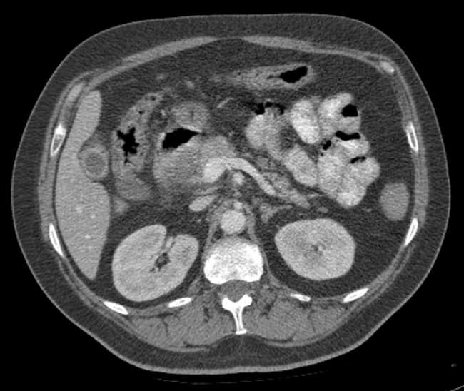Bleeding duodenal ulcer and adenomyomatosis of gallbladder (Radiopaedia 61834-69861 A 39).jpg