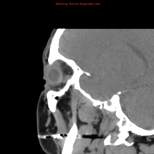 File:Blowout fracture with inferior rectus entrapment (Radiopaedia 12418-12673 C 4).jpg
