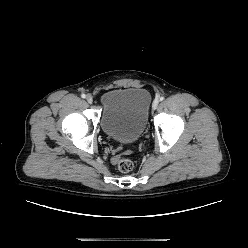 Blunt abdominal trauma with solid organ and musculoskelatal injury with active extravasation (Radiopaedia 68364-77895 A 142).jpg