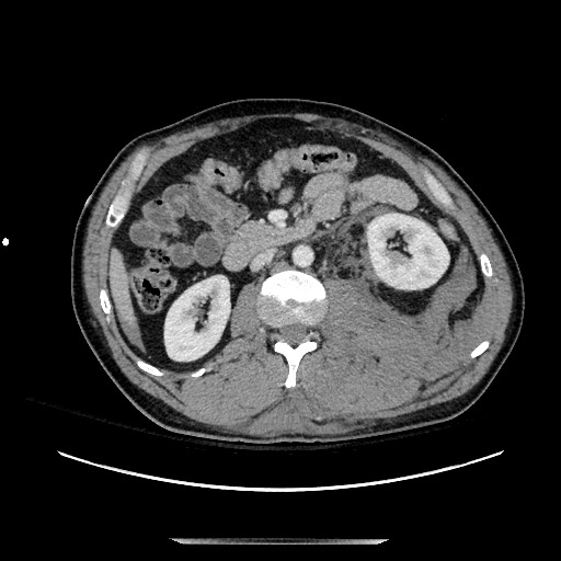 Blunt abdominal trauma with solid organ and musculoskelatal injury with active extravasation (Radiopaedia 68364-77895 A 64).jpg