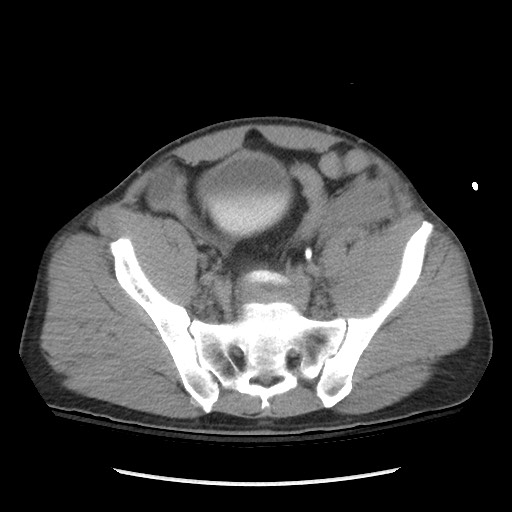 Blunt abdominal trauma with solid organ and musculoskelatal injury with active extravasation (Radiopaedia 68364-77895 Axial C+ delayed 109).jpg