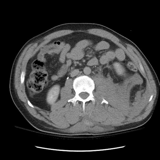 File:Blunt abdominal trauma with solid organ and musculoskelatal injury with active extravasation (Radiopaedia 68364-77895 Axial C+ delayed 67).jpg