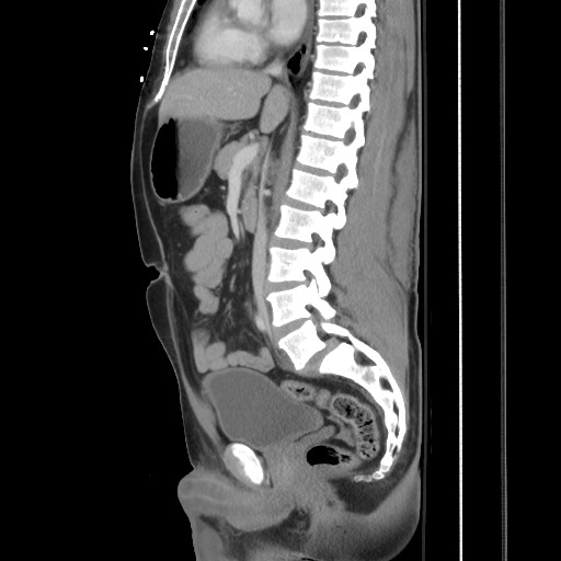 File:Blunt abdominal trauma with solid organ and musculoskelatal injury with active extravasation (Radiopaedia 68364-77895 C 73).jpg