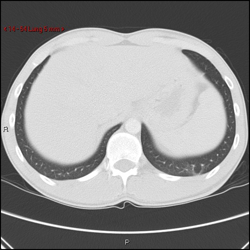 Blunt chest trauma - pulmonary interstitial emphysema and pneumomediastinum (Radiopaedia 20666-20552 Axial lung window 54).jpg