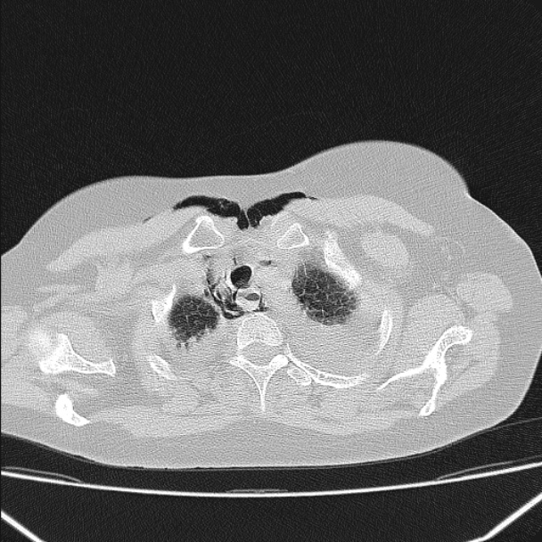 Boerhaave syndrome (Radiopaedia 45644-49799 Axial lung window 34).jpg