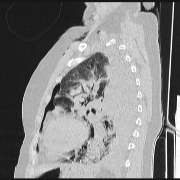 Boerhaave syndrome (Radiopaedia 45644-49799 Sagittal lung window 57).jpg