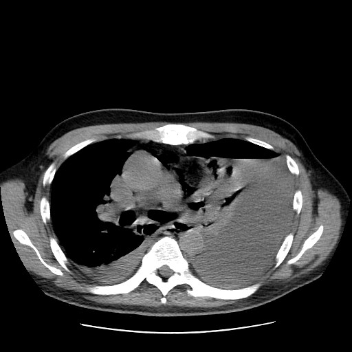 Boerhaave syndrome (Radiopaedia 59796-67310 Axial liver window 28).jpg