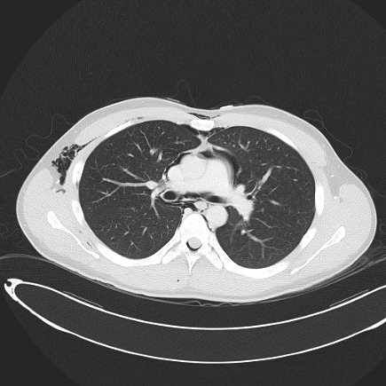 Boerhaave syndrome with mediastinal, axillary, neck and epidural free gas (Radiopaedia 41297-44115 Axial lung window 47).jpg