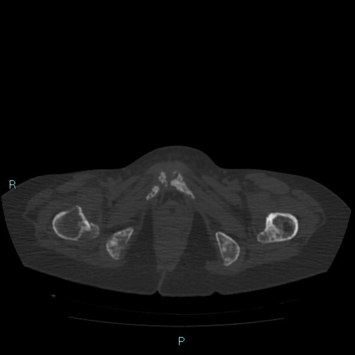 Bone metastases from untreated breast cancer (Radiopaedia 42973-46219 Axial bone window 200).jpg