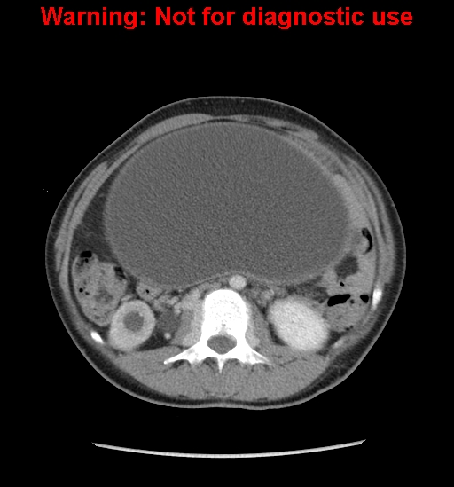 Borderline mucinous cystadenoma of ovary (Radiopaedia 25586-25767 A 18).jpg