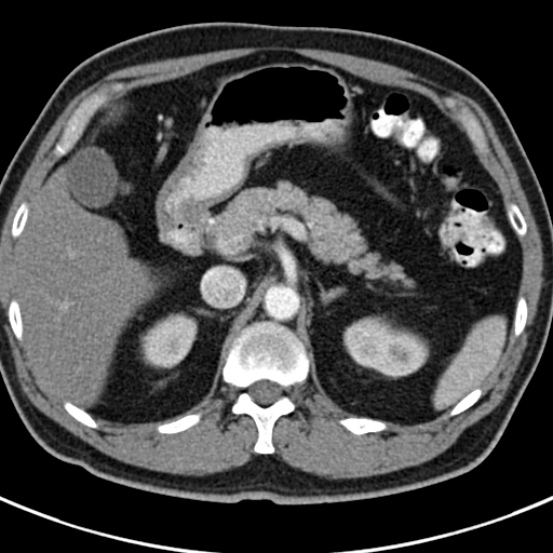 File:Bosniak cyst - type IV (Radiopaedia 23525-23627 renal cortical phase 10).jpg