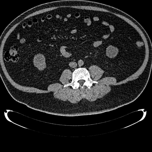 Bosniak renal cyst - type IV (Radiopaedia 24244-24518 Axial non-contrast 195).jpg