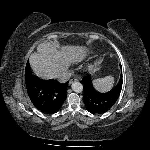 Bovine aortic arch - right internal mammary vein drains into the superior vena cava (Radiopaedia 63296-71875 A 120).jpg