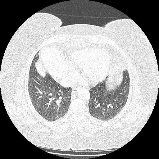 Bovine aortic arch - right internal mammary vein drains into the superior vena cava (Radiopaedia 63296-71875 Axial lung window 114).jpg