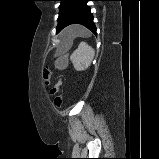 Bowel and splenic infarcts in acute lymphocytic leukemia (Radiopaedia 61055-68913 C 21).jpg