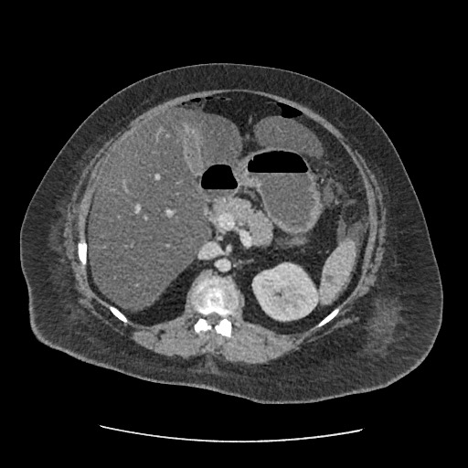 Bowel and splenic infarcts in acute lymphocytic leukemia (Radiopaedia 61055-68915 A 54).jpg