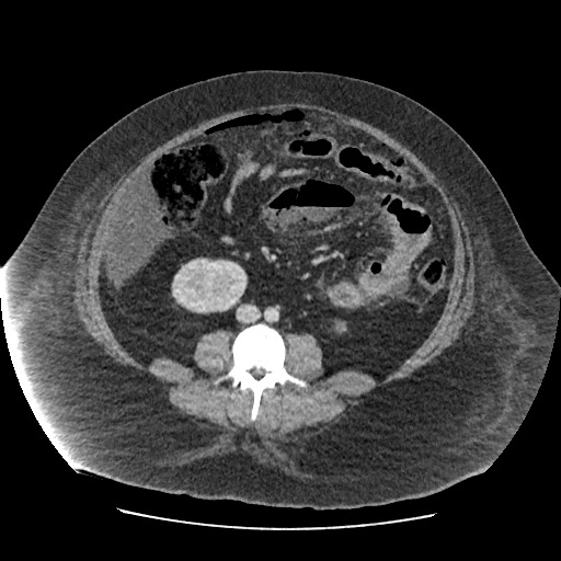 Bowel and splenic infarcts in acute lymphocytic leukemia (Radiopaedia 61055-68915 A 77).jpg