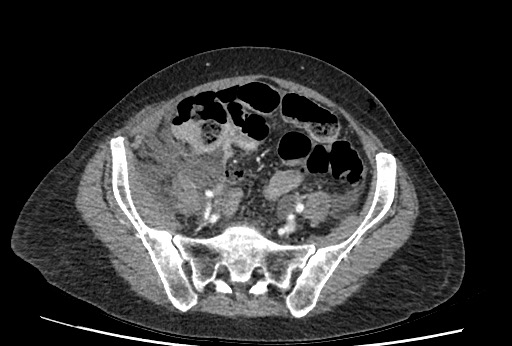 Bowel perforation at ERCP (Radiopaedia 59094-66394 C 52).jpg