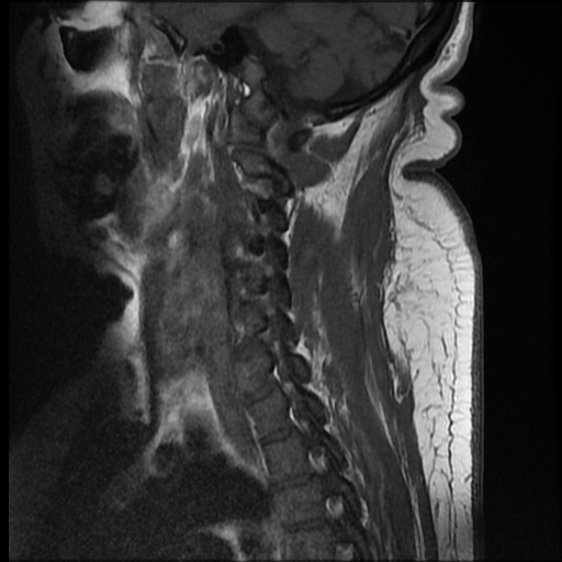 File:Brachial plexopathy (Radiopaedia 21844-21806 Sagittal T1 C+ 3).jpg