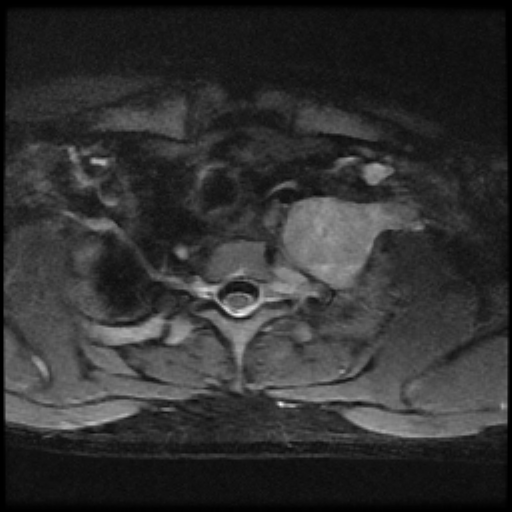 File:Brachial plexus neurofibroma (Radiopaedia 28030-28291 Axial STIR 6).png