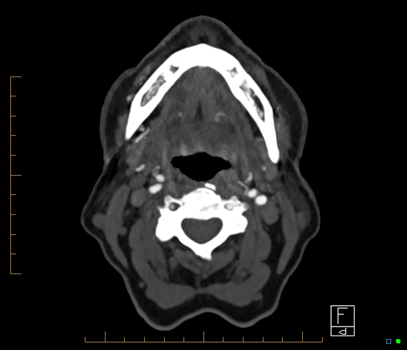 Brachiocephalic trunk stenosis (Radiopaedia 87242-103519 A 85).jpg