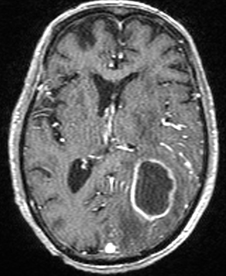 Brain abscess with dual rim sign (Radiopaedia 87566-103938 Axial T1 C+ 90).jpg
