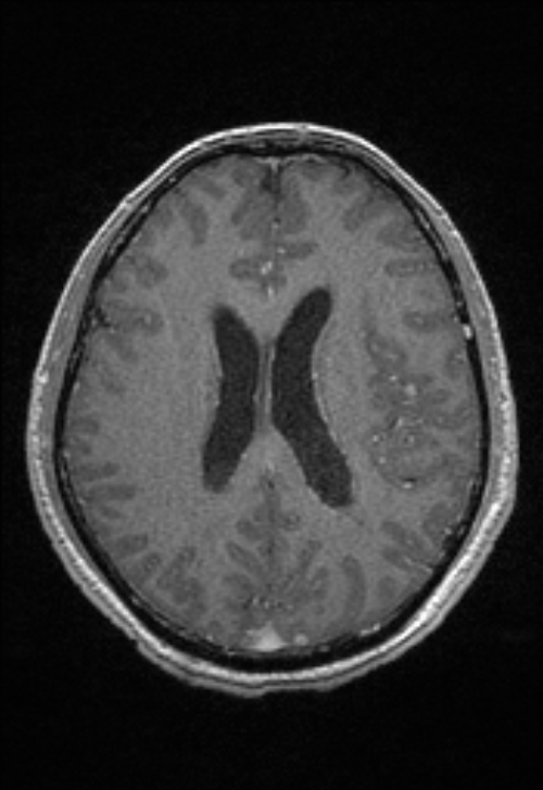 Brain abscess with ventriculitis (Radiopaedia 85703-101495 Axial T1 C+ 112).jpg