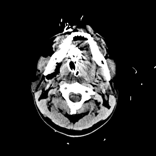 File:Brain contusions, internal carotid artery dissection and base of skull fracture (Radiopaedia 34089-35339 Axial non-contrast 9).png
