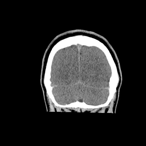 Brain death (Radiopaedia 78597-91360 Coronal non-contrast 65).jpg