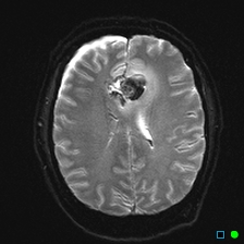 File:Brain death on MRI and CT angiography (Radiopaedia 42560-45689 Axial ADC 21).jpg