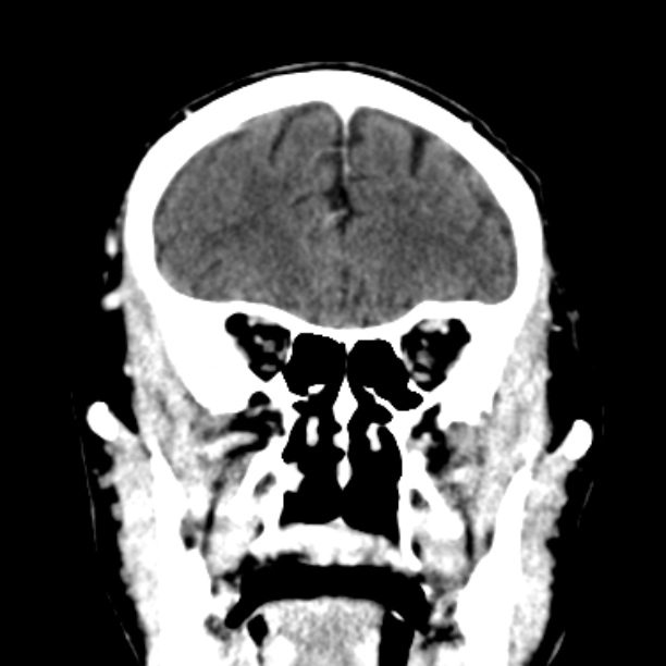 Brain metastases from lung cancer (Radiopaedia 27849-28092 Coronal C+ delayed 17).jpg
