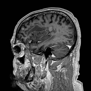 Brain metastases from lung cancer (Radiopaedia 83839-99028 Sagittal T1 C+ 14).jpg