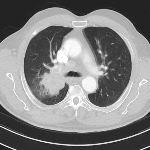 File:Brain metastasis (large cystic mass) (Radiopaedia 47497-52104 Axial lung window 17).png