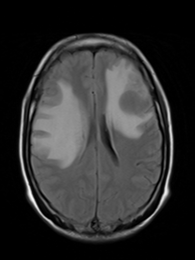 File:Brain metastasis as initial presentation of non-small cell lung cancer (Radiopaedia 65122-74126 Axial FLAIR 13).jpg